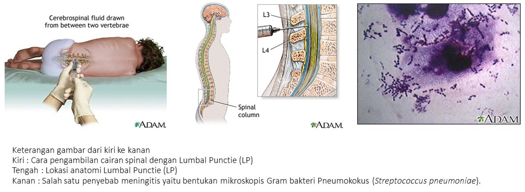 MENINGITIS BAKTERI
